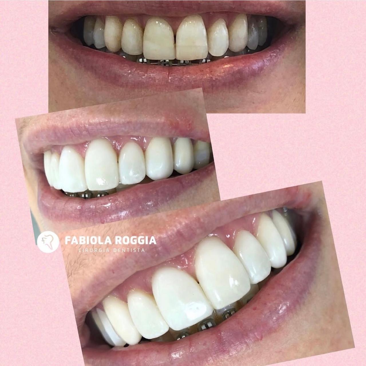 Facetas em resina composta