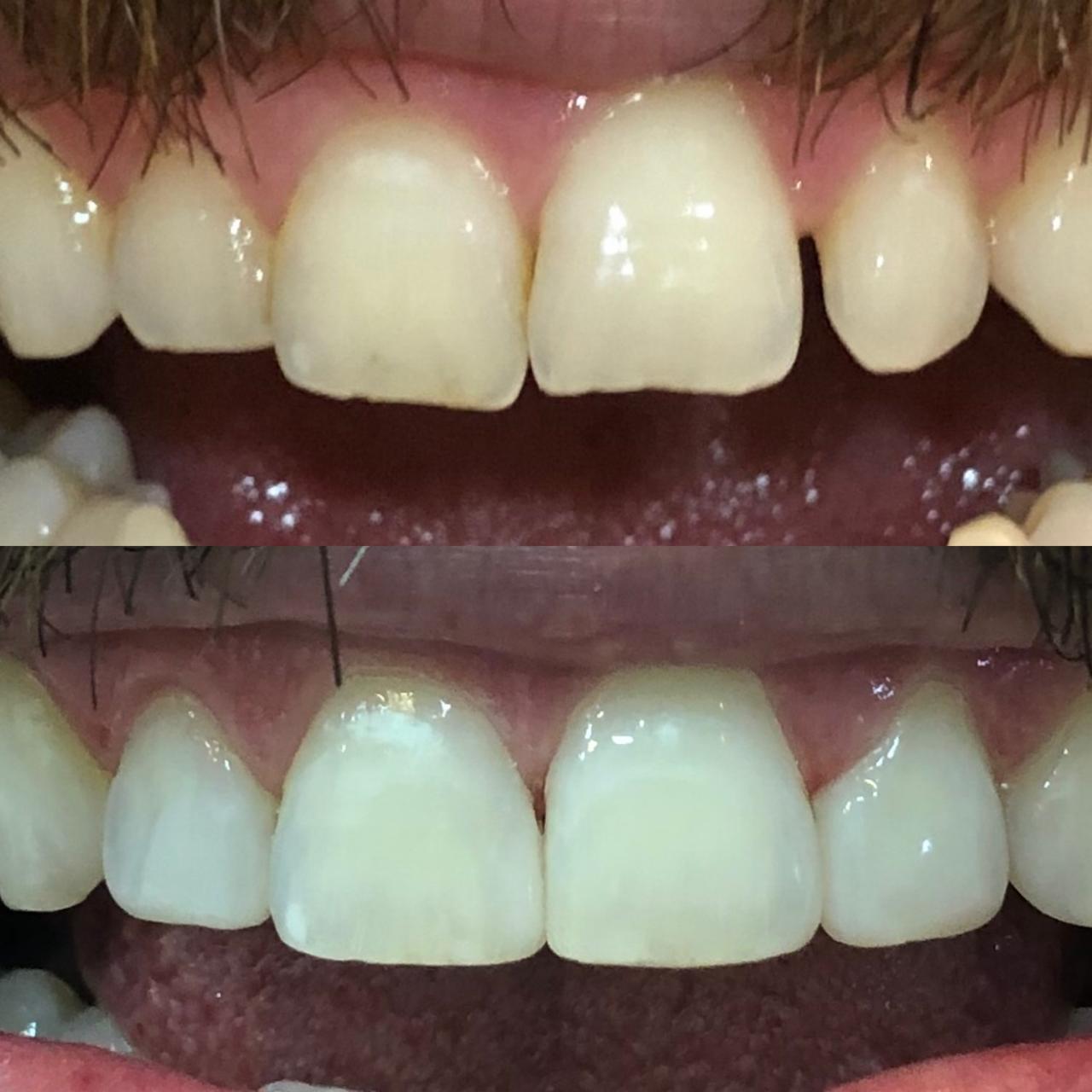 Reanatomização de dentes hígidos com necessidade de alteração estética