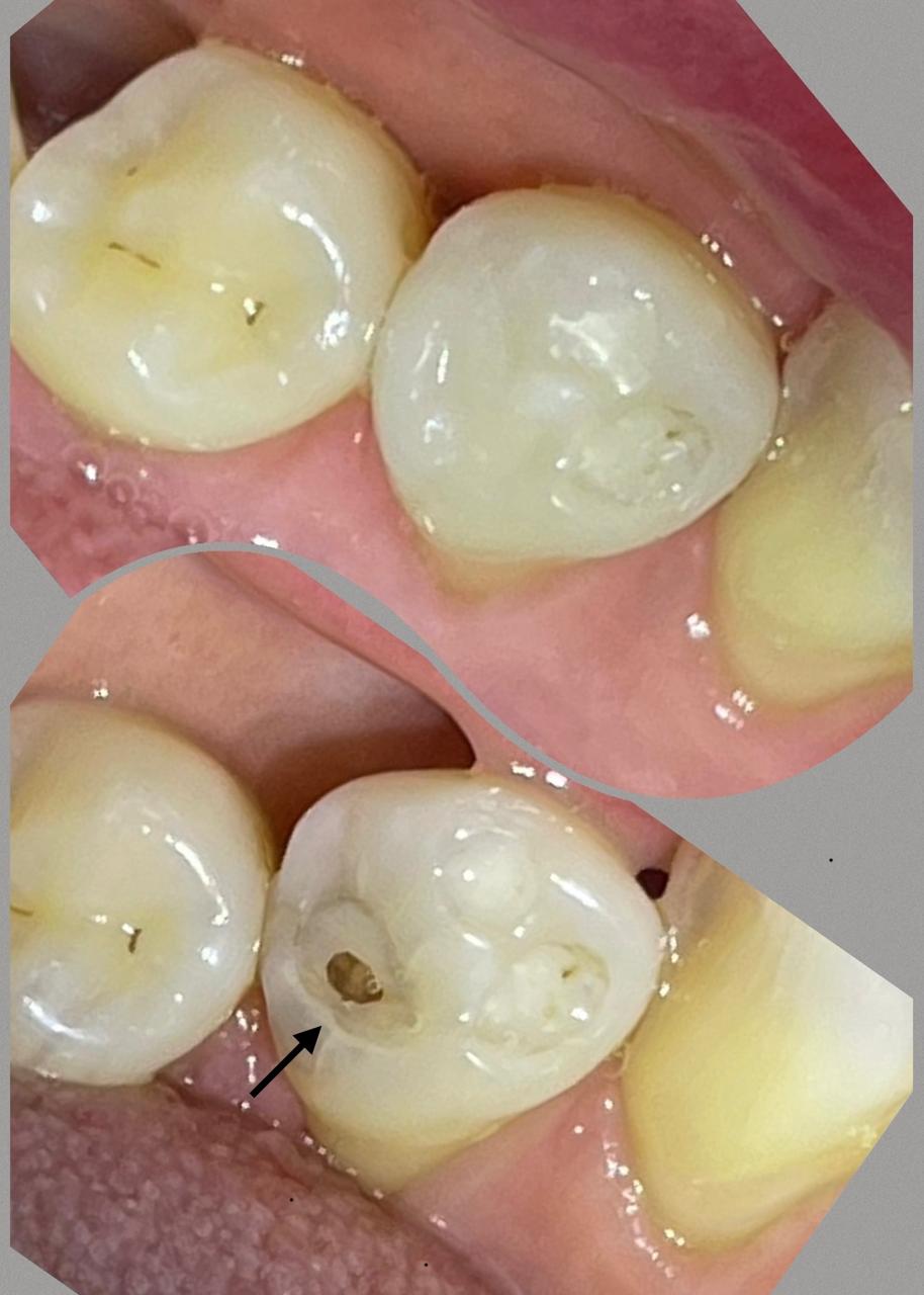 Restauração de lesões por cárie